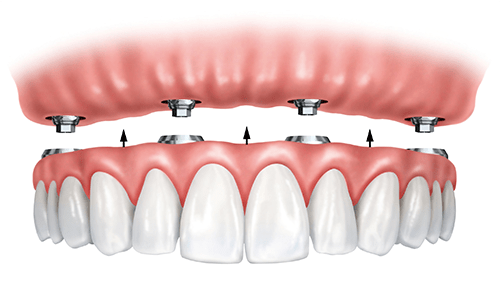 Example of All-on-4 Dental Implants